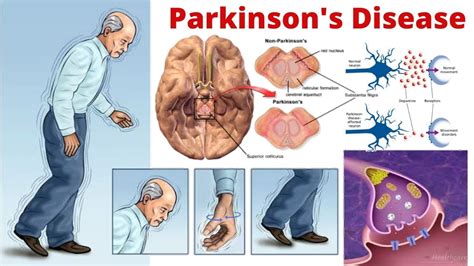 is parkinson's a neurological condition